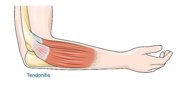 Tendinit Yoga