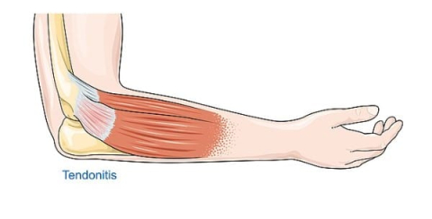 Tendinit için Yoga